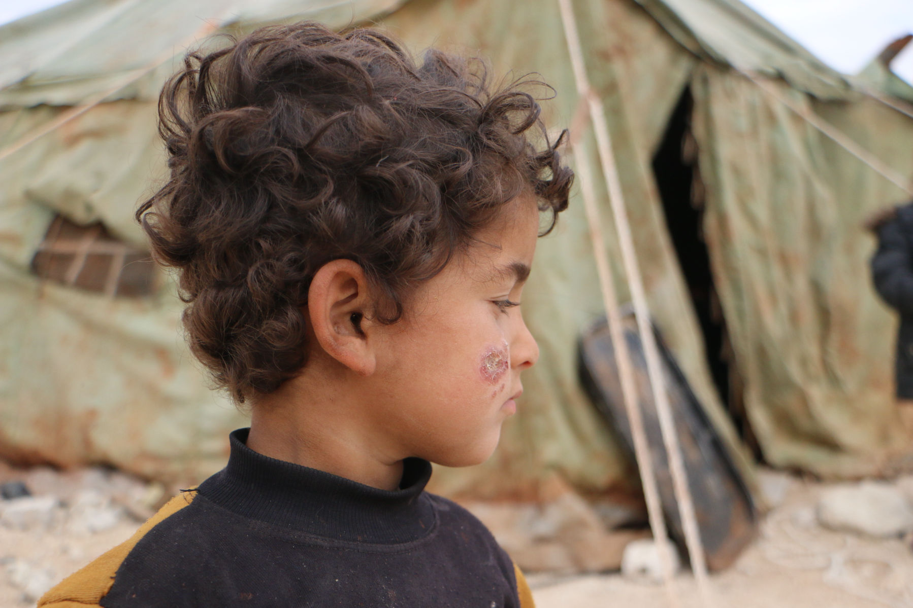 Un cas de leishmaniose cutanée dans le camp de Deir Hassan, en Syrie. Photo : Abdul Majeed Al Qareh.